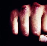 چگونه بدون درد و بدون دلیل شکستن یک دست و صدمه ببینیم