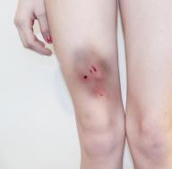 รอยฟกช้ำที่ขาโดยไม่มีเหตุผลในผู้หญิง: ปัจจัยกระตุ้น, การรักษา